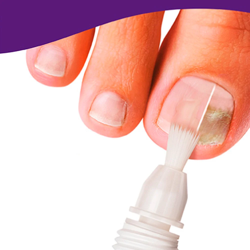 Mycosana Treatment and Prevention of Onychomycosis